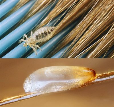 Головна воша - крихітного розміру комаха, що паразитує на людському тілі